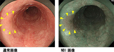 通常画像とNBI画像