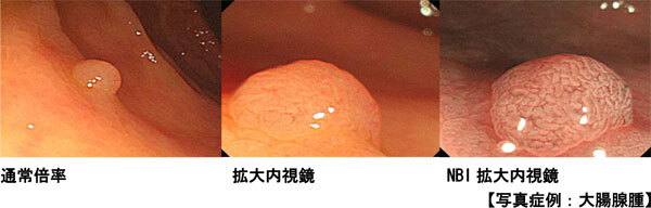 通常倍率と拡大内視鏡とNBI拡大内視鏡【写真症例：大腸腺腫】