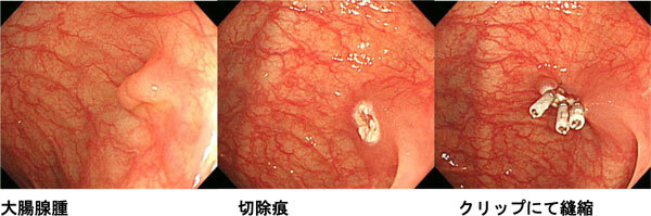 大腸腺腫と切除痕とクリップにて縫縮